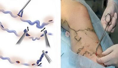 Flebectomy for varicose veins on the feet