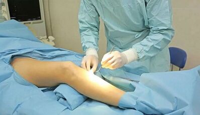 How operations are performed with varicose veins