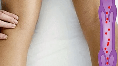 Reason -As the development of varicose veins in the lower lower leg