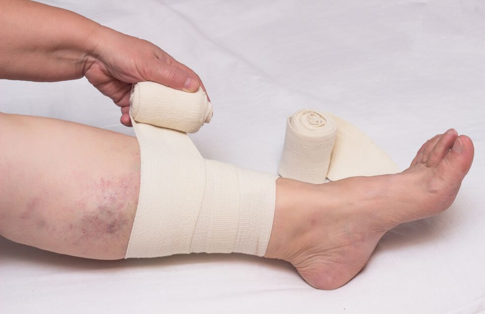 Varicose vein compression treatment